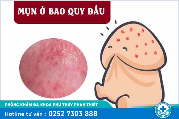 Nổi mụn ở bao quy đầu có sao không? Cách khắc phục hiệu quả ra sao?
