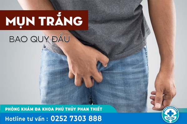 Mụn trắng ở dương vật là bệnh gì?