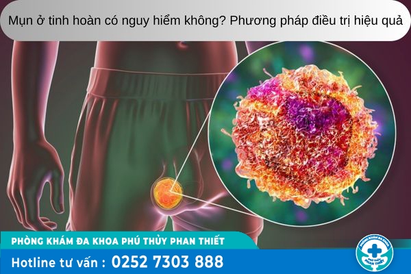 Mụn ở tinh hoàn có nguy hiểm không? Phương pháp điều trị hiệu quả