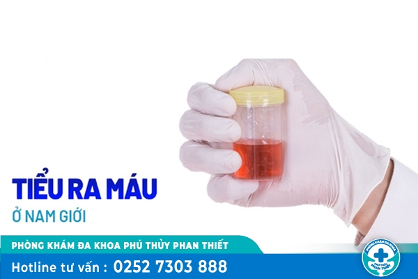Tiểu ra máu là bệnh gì ở nam?